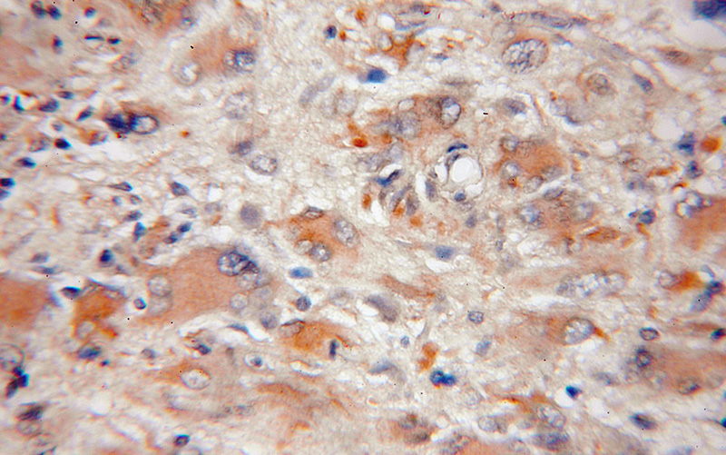 Immunohistochemical of paraffin-embedded human gliomas using Catalog No:111138(GPRASP2 antibody) at dilution of 1:50 (under 10x lens)