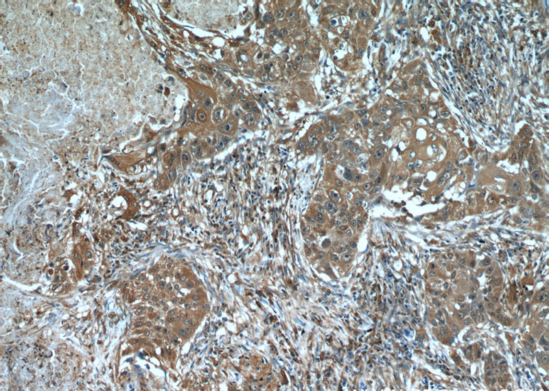 Immunohistochemical of paraffin-embedded human lung cancer using Catalog No:109814(KRT8 antibody) at dilution of 1:50 (under 10x lens)