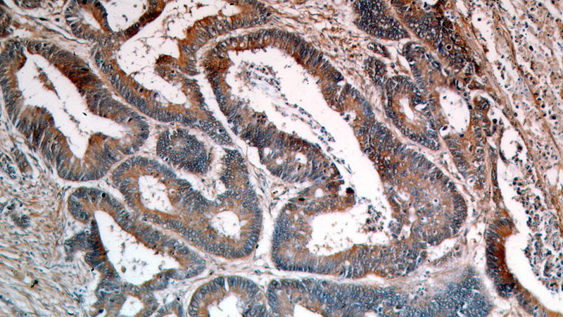 Immunohistochemical of paraffin-embedded human colon cancer using Catalog No:113989(PDPN,D2-40,M2A antibody) at dilution of 1:50 (under 10x lens)