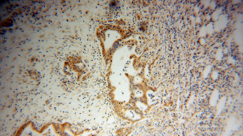 Immunohistochemical of paraffin-embedded human pancreas cancer using Catalog No:107069(ATF4 antibody) at dilution of 1:100 (under 10x lens)