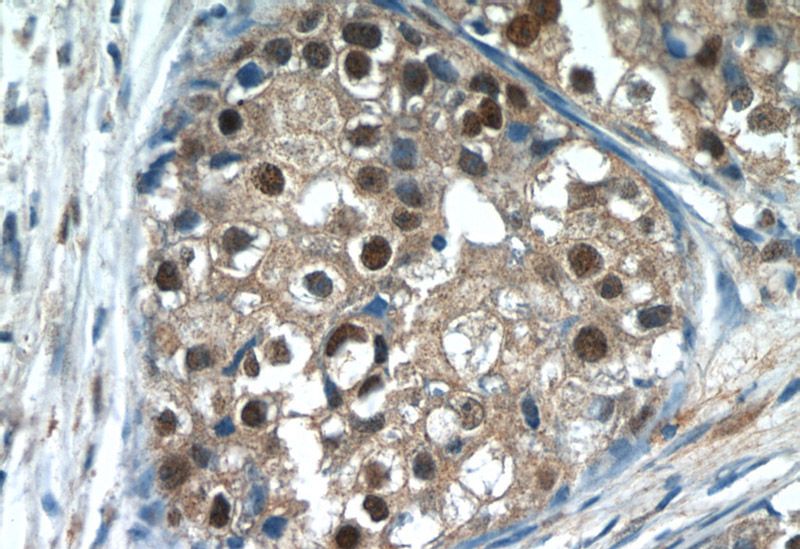 Immunohistochemistry of paraffin-embedded human breast cancer tissue slide using Catalog No:112567(MDC1 Antibody) at dilution of 1:50 (under 40x lens)