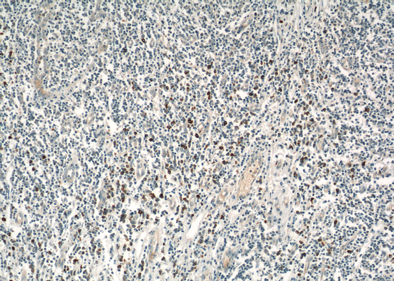 Immunohistochemical of paraffin-embedded human tonsillitis using Catalog No:111428(HLA-DRB5 antibody) at dilution of 1:50 (under 10x lens)