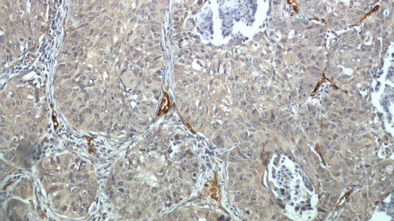 Immunohistochemical of paraffin-embedded human lung cancer using Catalog No:115942(CD248 antibody) at dilution of 1:100 (under 10x lens)