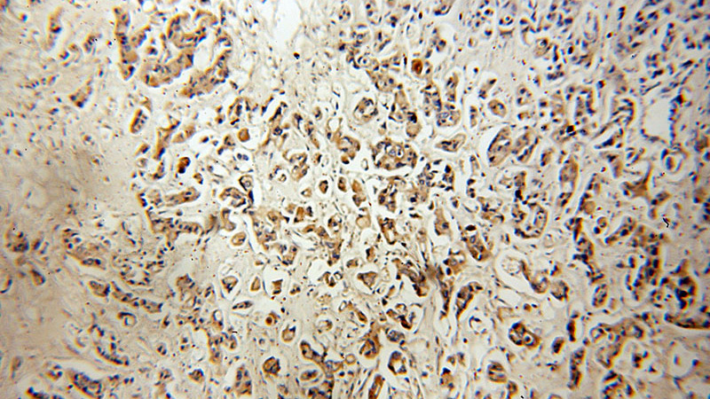 Immunohistochemical of paraffin-embedded human breast cancer using Catalog No:111684(IGFBP2 antibody) at dilution of 1:50 (under 10x lens)