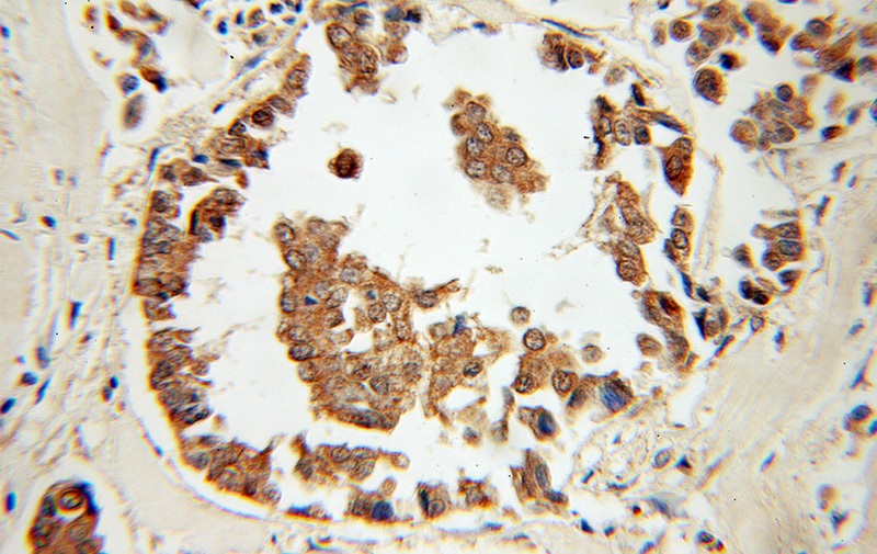 Immunohistochemical of paraffin-embedded human breast cancer using Catalog No:110162(EAF2 antibody) at dilution of 1:50 (under 10x lens)