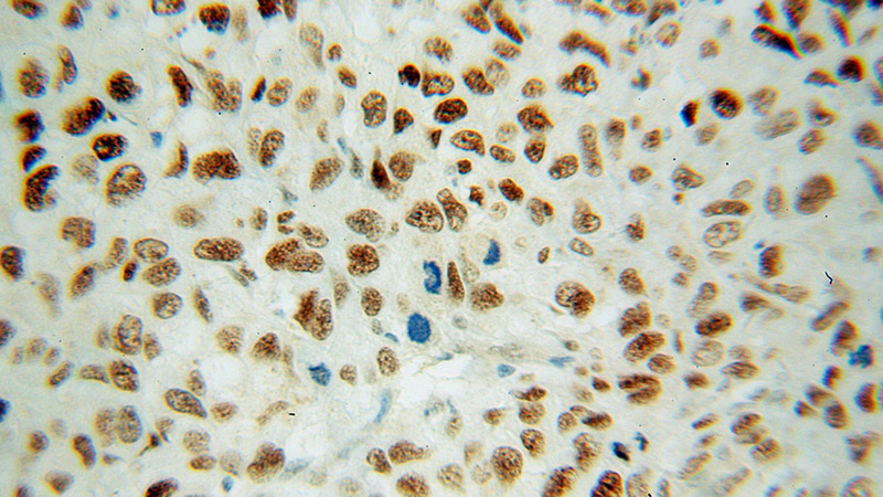Immunohistochemical of paraffin-embedded human lung cancer using Catalog No:110538(FBLIM1 antibody) at dilution of 1:100 (under 40x lens)