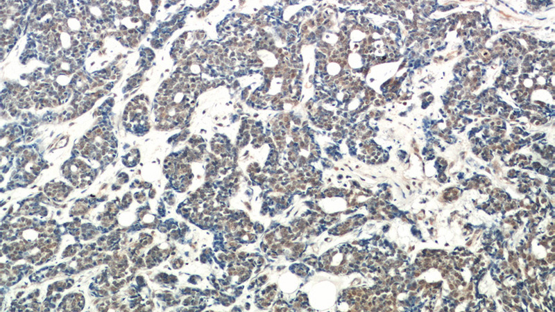 Immunohistochemical of paraffin-embedded human cervical cancer using Catalog No:107948(AKT antibody) at dilution of 1:50 (under 10x lens)