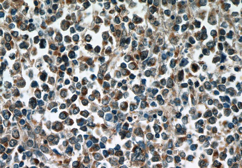 Immunohistochemistry of paraffin-embedded human lymphoma tissue slide using Catalog No:114684(RELB Antibody) at dilution of 1:50 (under 40x lens)