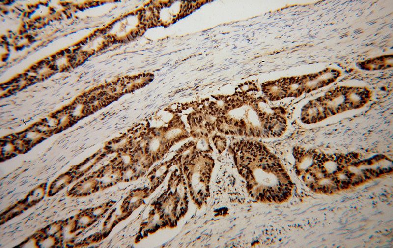 Immunohistochemical of paraffin-embedded human colon cancer using Catalog No:110675(FKBP5 antibody) at dilution of 1:50 (under 10x lens)