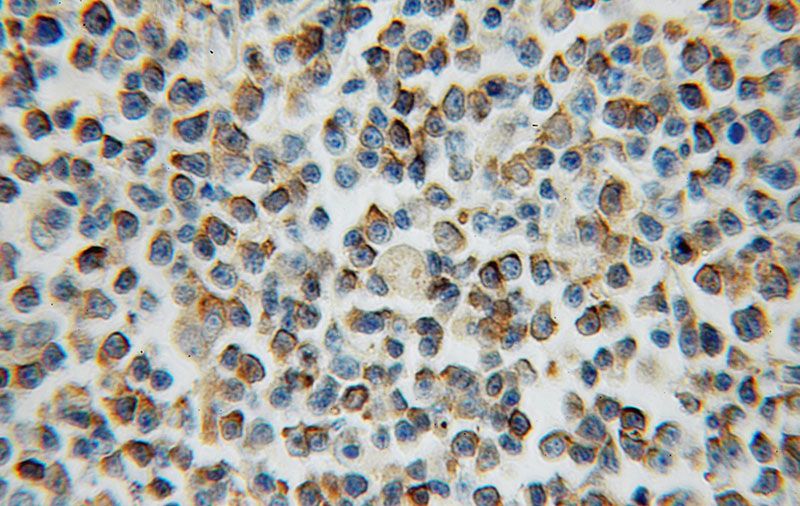 Immunohistochemical of paraffin-embedded human lymphoma using Catalog No:108197(ARL15 antibody) at dilution of 1:50 (under 40x lens)