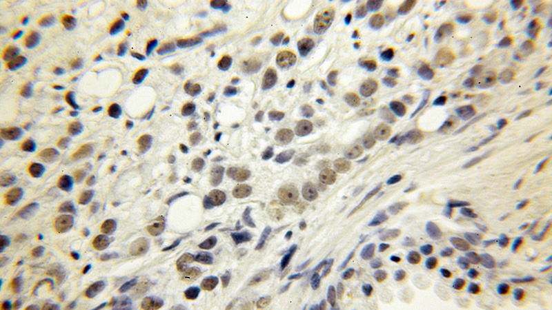Immunohistochemical of paraffin-embedded human prostate cancer using Catalog No:112116(KPNA6 antibody) at dilution of 1:50 (under 10x lens)