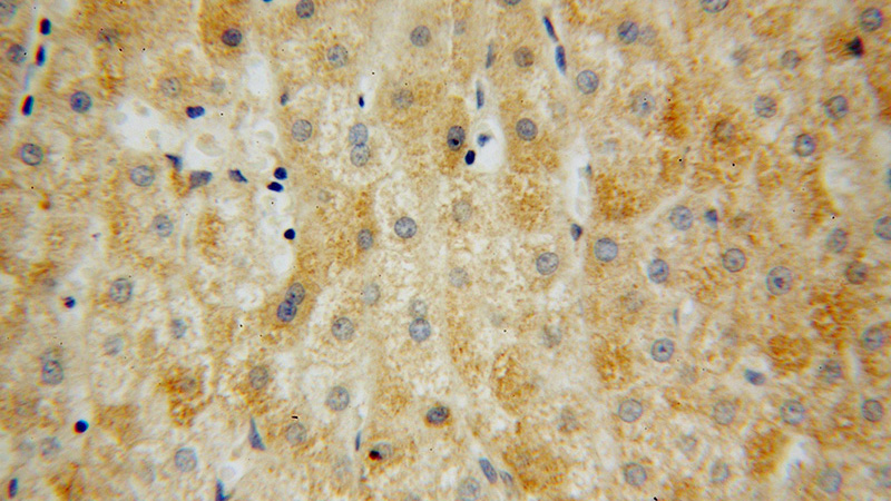 Immunohistochemical of paraffin-embedded human liver cancer using Catalog No:112824(MRPL34 antibody) at dilution of 1:100 (under 40x lens)