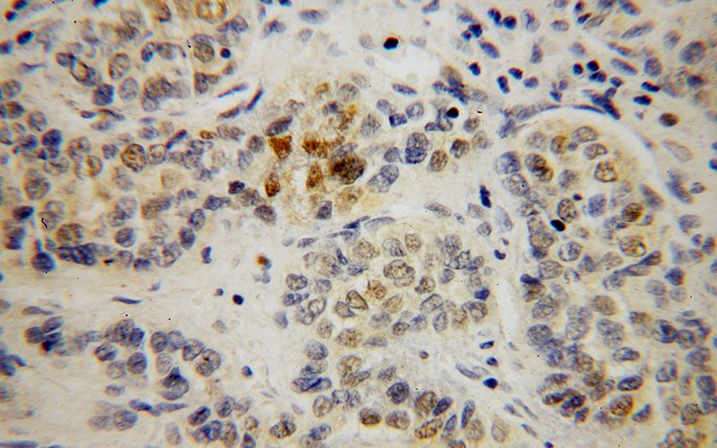 Immunohistochemical of paraffin-embedded human liver cancer using Catalog No:114001(POLE3 antibody) at dilution of 1:100 (under 40x lens)