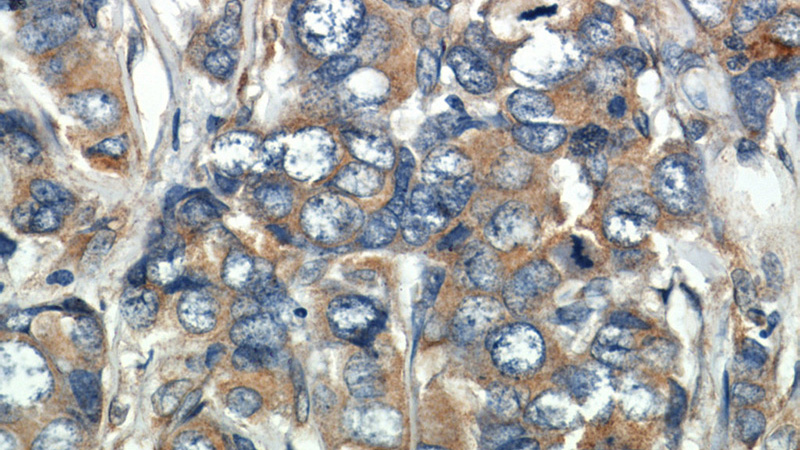 Immunohistochemistry of paraffin-embedded human breast cancer slide using Catalog No:108246(ARF4 Antibody) at dilution of 1:50 (under 40x lens)