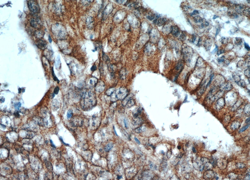 Immunohistochemical of paraffin-embedded human colon cancer using Catalog No:109244(CEACAM3-Specific antibody) at dilution of 1:50 (under 40x lens)