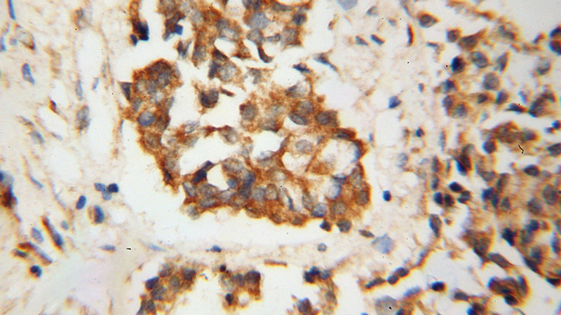 Immunohistochemical of paraffin-embedded human breast cancer using Catalog No:109919(DHODH antibody) at dilution of 1:100 (under 40x lens)