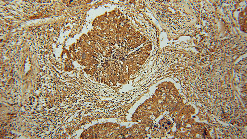 Immunohistochemical of paraffin-embedded human ovary tumor using Catalog No:113398(NUTF2 antibody) at dilution of 1:100 (under 10x lens)