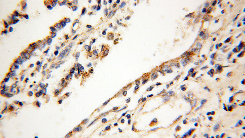 Immunohistochemical of paraffin-embedded human lung cancer using Catalog No:111943(hIST1 antibody) at dilution of 1:200 (under 40x lens)