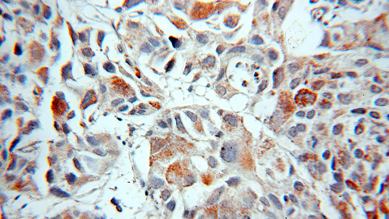 Immunohistochemical of paraffin-embedded human prostate cancer using Catalog No:112628(MIPEP antibody) at dilution of 1:50 (under 10x lens)