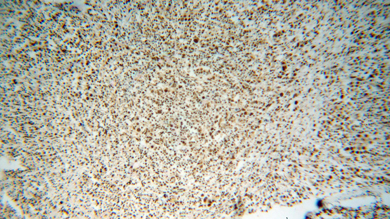 Immunohistochemical of paraffin-embedded human breast cancer using Catalog No:116466(BAT1 antibody) at dilution of 1:100 (under 10x lens)