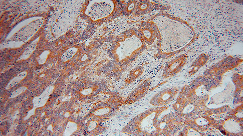 Immunohistochemical of paraffin-embedded human colon cancer using Catalog No:114564(RBP7 antibody) at dilution of 1:50 (under 10x lens)