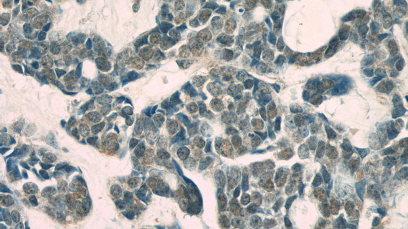 Immunohistochemical of paraffin-embedded human cervical cancer using Catalog No:107532(USP1 antibody) at dilution of 1:50 (under 40x lens)