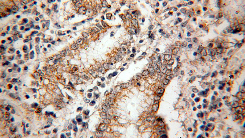 Immunohistochemical of paraffin-embedded human stomach cancer using Catalog No:113497(PAK1 antibody) at dilution of 1:100 (under 40x lens)