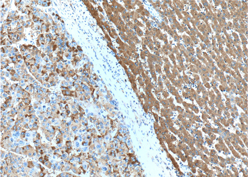 Immunohistochemistry of paraffin-embedded human liver cancer tissue slide using Catalog No:107701(ACSM5 Antibody) at dilution of 1:50 (under 10x lens)