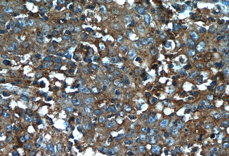 Immunohistochemistry of paraffin-embedded human colon cancer tissue slide using Catalog No:108392(B4GALNT2 Antibody) at dilution of 1:50 (under 40x lens)