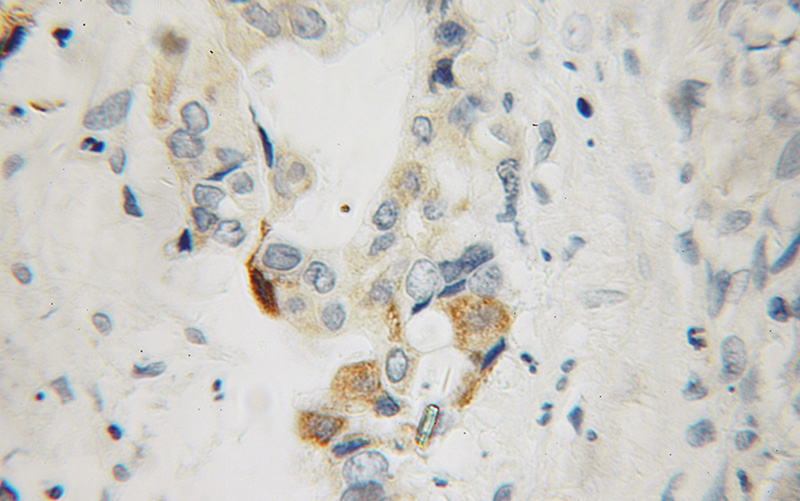 Immunohistochemical of paraffin-embedded human pancreas cancer using Catalog No:115720(STK33 antibody) at dilution of 1:100 (under 10x lens)