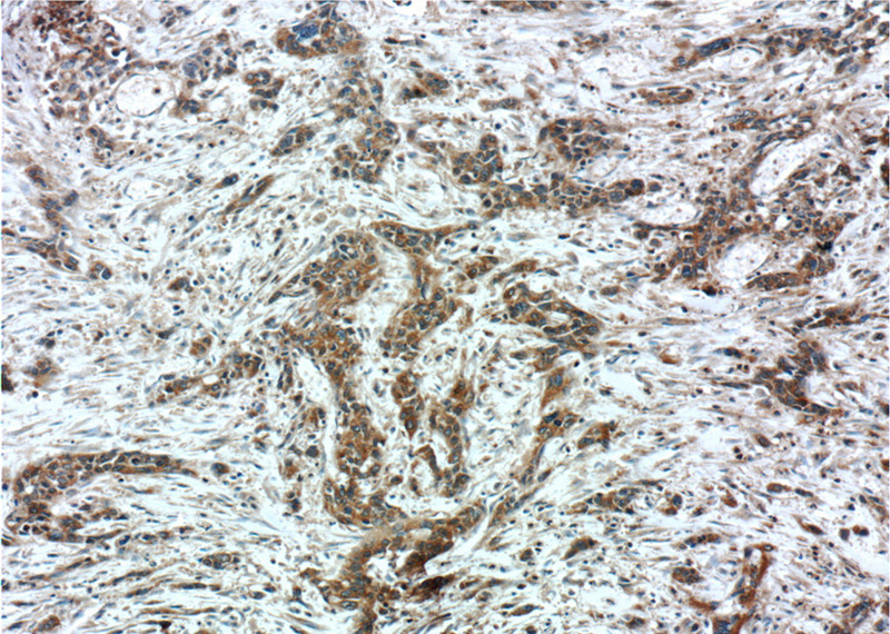 Immunohistochemistry of paraffin-embedded human stomach cancer tissue slide using Catalog No:114252(PSMG3 Antibody) at dilution of 1:50 (under 10x lens)