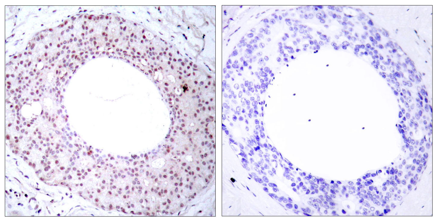 Immunohistochemical analysis of paraffin-embedded human breast carcinoma tissue using NFκB-p65 (Phospho-Thr254) Antibody  (left) or the same antibody preincubated with blocking peptide (right).