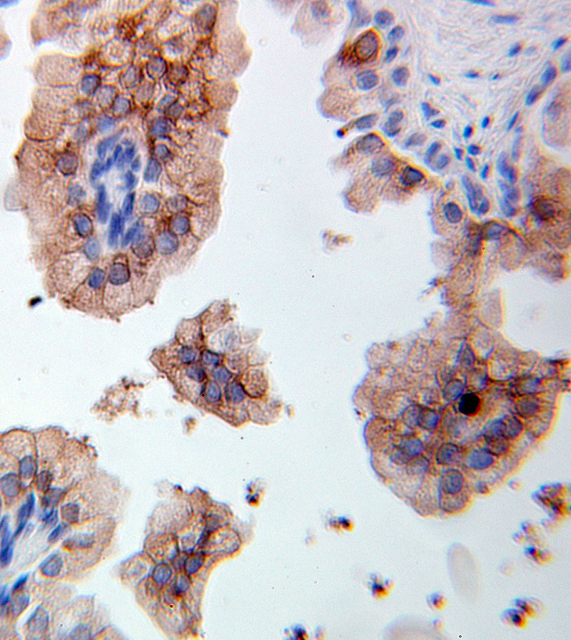 Immunohistochemical of paraffin-embedded human prostate cancer using Catalog No:113748(PCOLCE2 antibody) at dilution of 1:100 (under 25x lens)