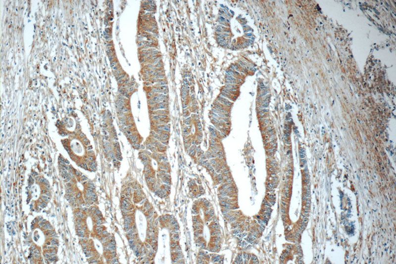 Immunohistochemistry of paraffin-embedded human colon cancer tissue slide using Catalog No:108704(C20orf46 Antibody) at dilution of 1:50 (under 10x lens)