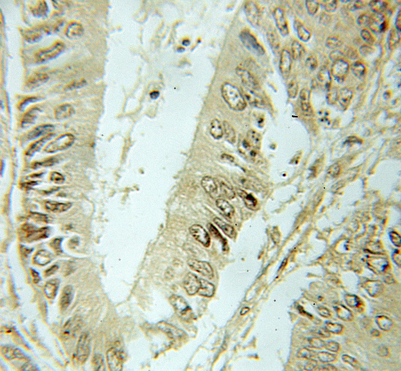 Immunohistochemical of paraffin-embedded human colon cancer using Catalog No:115137(SF3B2 antibody) at dilution of 1:10 (under 40x lens)