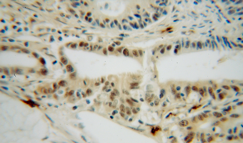 Immunohistochemical of paraffin-embedded human colon cancer using Catalog No:114127(PPIL1 antibody) at dilution of 1:100 (under 40x lens)