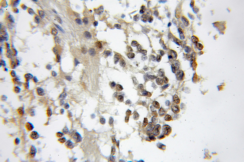 Immunohistochemical of paraffin-embedded human gliomas using Catalog No:108896(CBFA2T2 antibody) at dilution of 1:50 (under 10x lens)