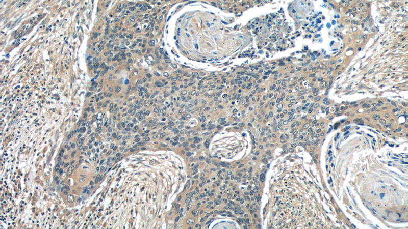 Immunohistochemistry of paraffin-embedded human cervical cancer tissue slide using Catalog No:115479(SNX27 Antibody) at dilution of 1:50 (under 10x lens)