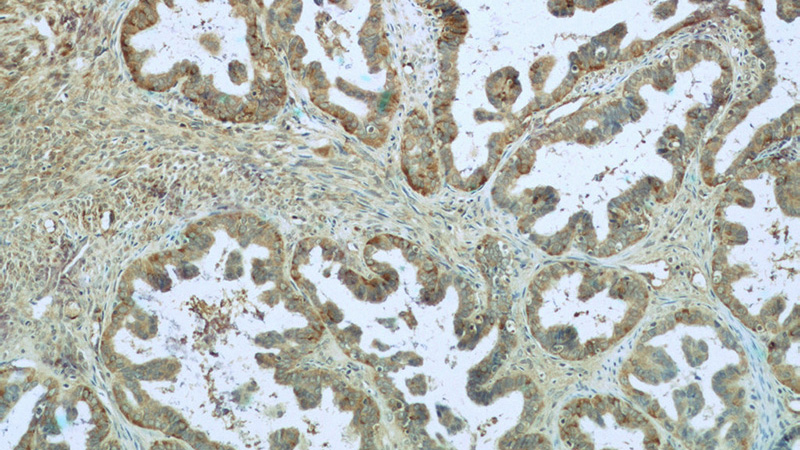 Immunohistochemistry of paraffin-embedded human ovary tumor tissue slide using Catalog No:107181(CTAGE1 Antibody) at dilution of 1:50 (under 10x lens)