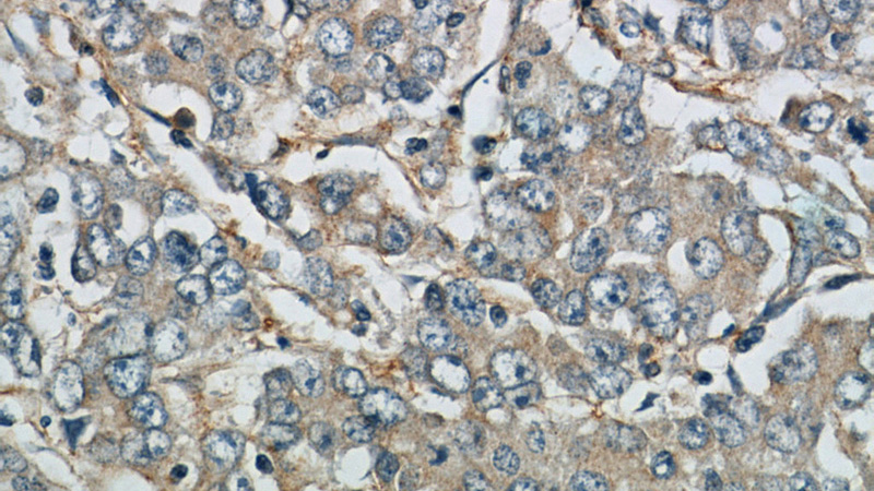 Immunohistochemistry of paraffin-embedded human stomach cancer tissue slide using Catalog No:110561(FBXW11 Antibody) at dilution of 1:100 (under 40x lens).
