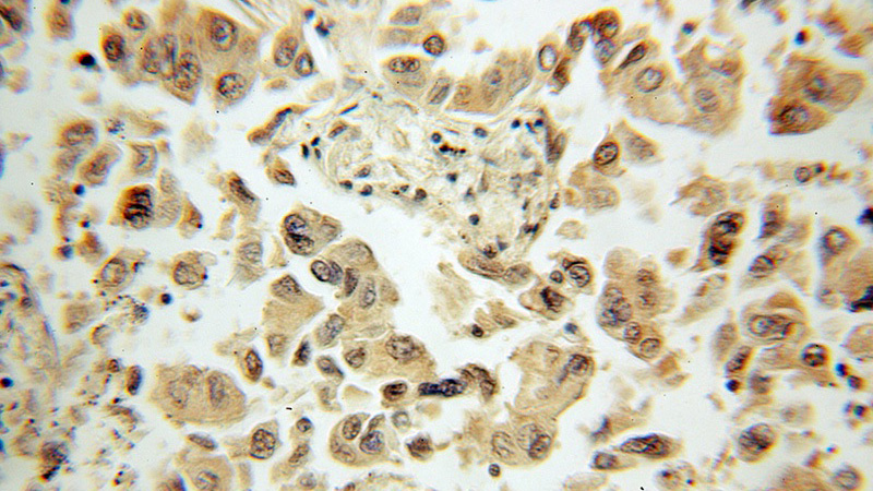 Immunohistochemical of paraffin-embedded human lung cancer using Catalog No:110189(EIF2S3 antibody) at dilution of 1:50 (under 10x lens)