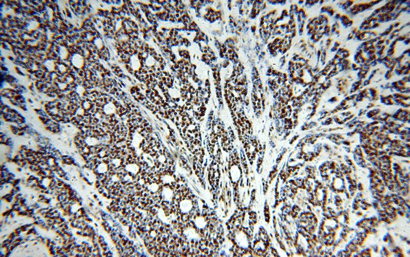 Immunohistochemical of paraffin-embedded human cervical cancer using Catalog No:114589(RBBP4 antibody) at dilution of 1:100 (under 10x lens)