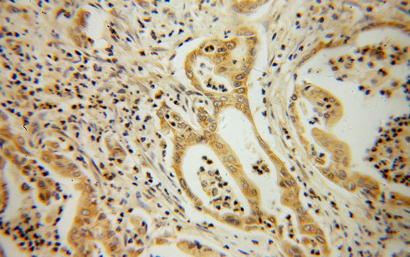 Immunohistochemical of paraffin-embedded human pancreas cancer using Catalog No:108328(ATX3,ATXN3 antibody) at dilution of 1:100 (under 40x lens)