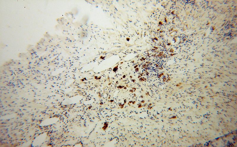 Immunohistochemical of paraffin-embedded human gliomas using Catalog No:108851(CPA6 antibody) at dilution of 1:100 (under 10x lens)