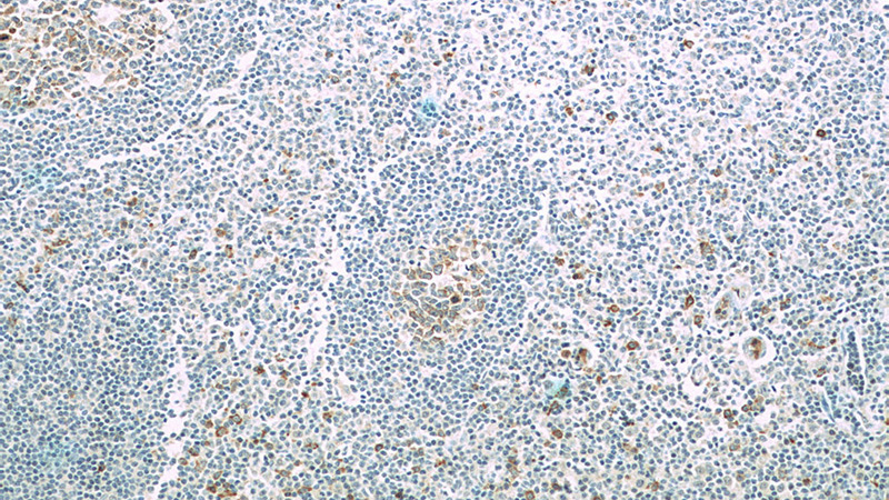 Immunohistochemistry of paraffin-embedded human tonsillitis tissue slide using (IL21R Antibody) at dilution of 1:100 (under 10x lens)