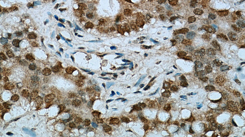 Immunohistochemical of paraffin-embedded human gliomas using Catalog No:110283(ELMOD1 antibody) at dilution of 1:100 (under 40x lens)