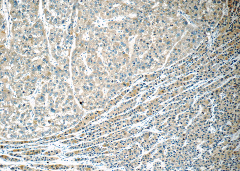 Immunohistochemistry of paraffin-embedded human liver cancer tissue slide using Catalog No:107695(ACSL1 Antibody) at dilution of 1:50 (under 10x lens)