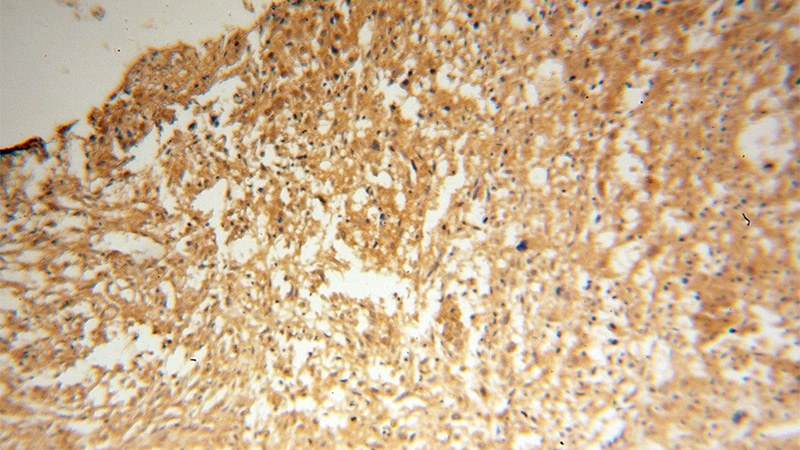 Immunohistochemical of paraffin-embedded human osteosarcoma using Catalog No:109456(COP1 antibody) at dilution of 1:100 (under 10x lens)