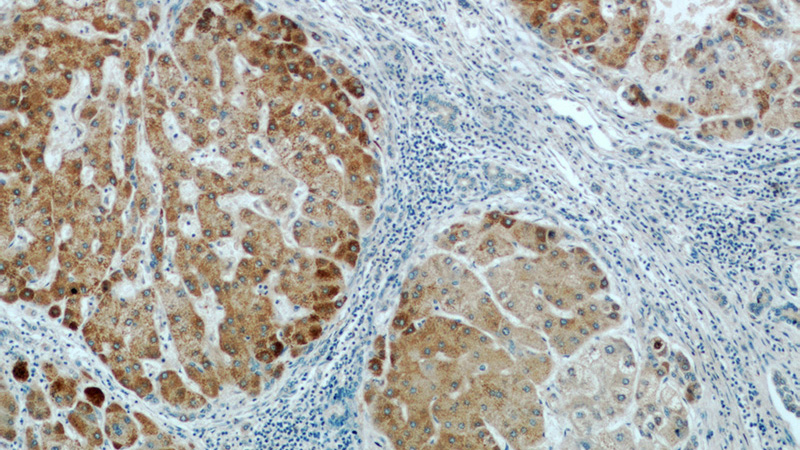 Immunohistochemical of paraffin-embedded human hepatocirrhosis using Catalog No:117013(ZNF622 antibody) at dilution of 1:100 (under 10x lens)