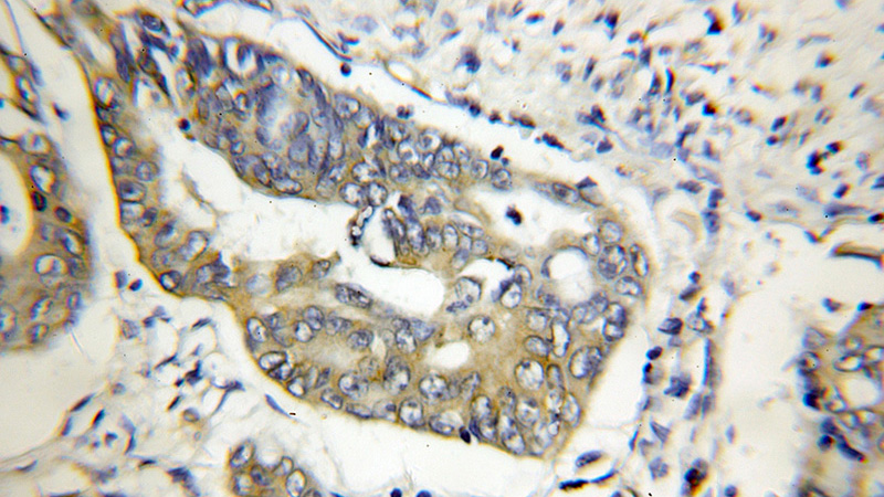 Immunohistochemical of paraffin-embedded human colon cancer using Catalog No:110535(FBF1 antibody) at dilution of 1:50 (under 10x lens)